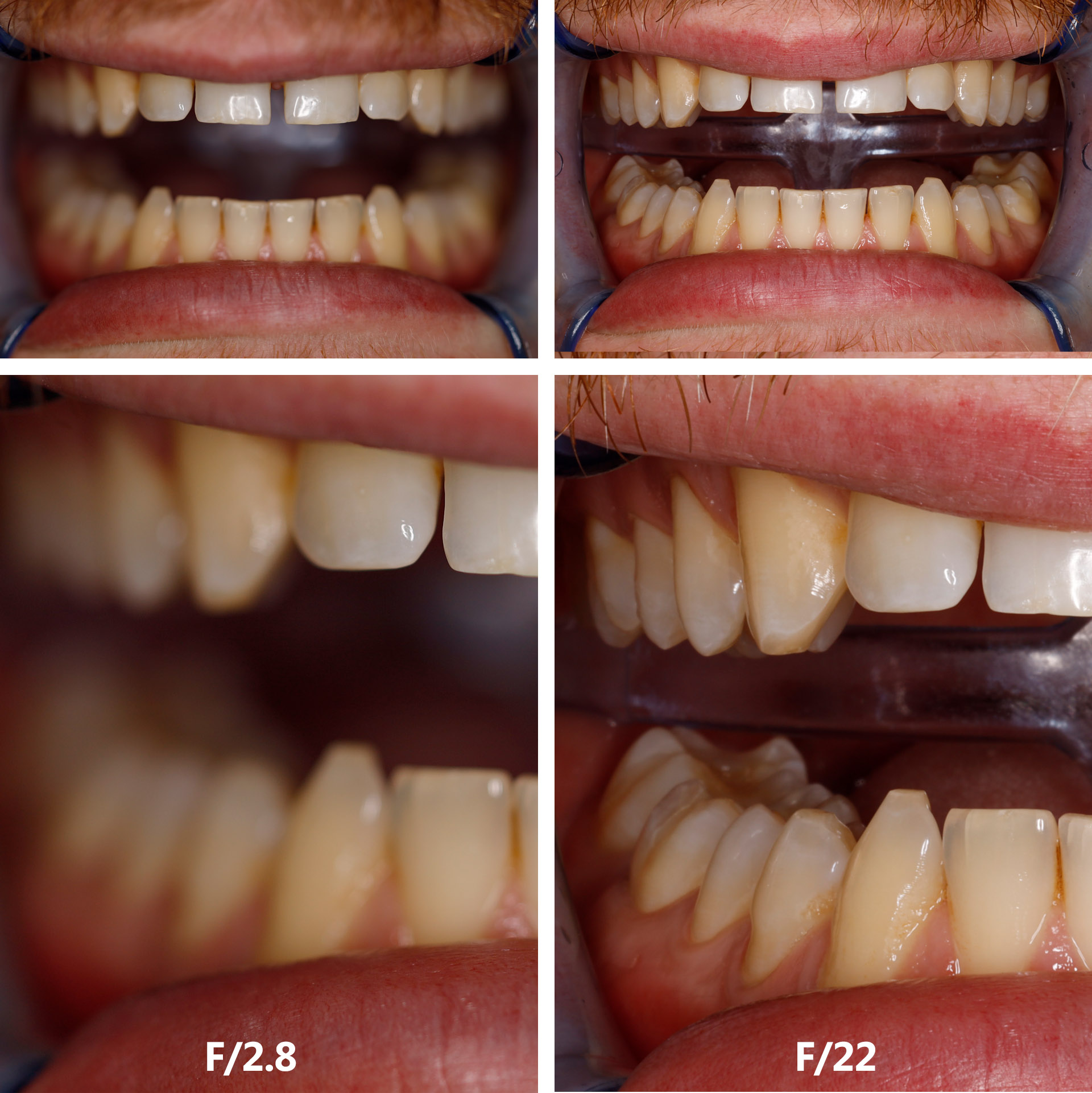 Fotografia stomatologiczna porównanie przysłon
